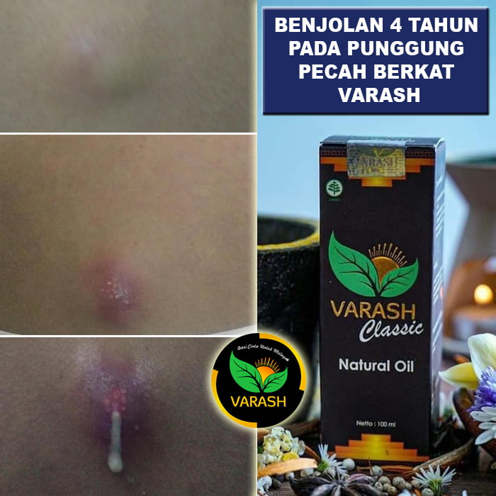 benjolan di punggung terbantu varash natural classic oil