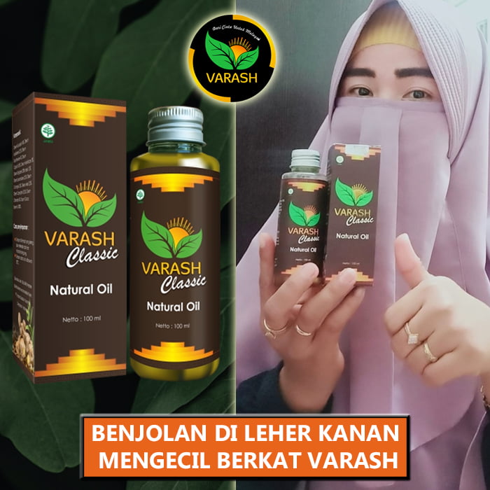 benjolan di leher terbantu varash natural classic oil