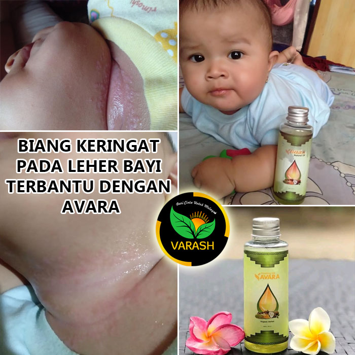 biang keringat terbantu varash natural avara oil