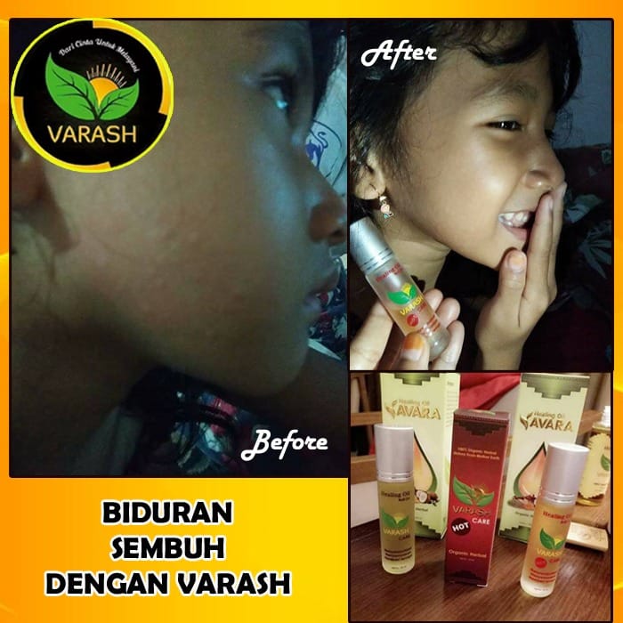 biduran dengan varash natural classic oil