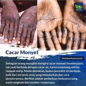 terapi cacar monyet dengan varash
