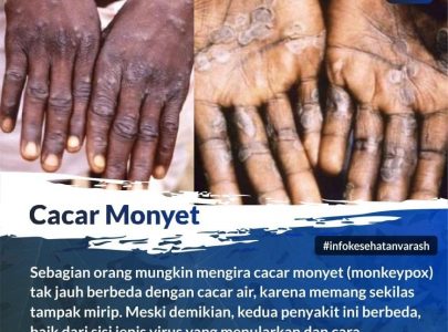 Penyakit Apa Cacar Monyet (Monkeypox)?