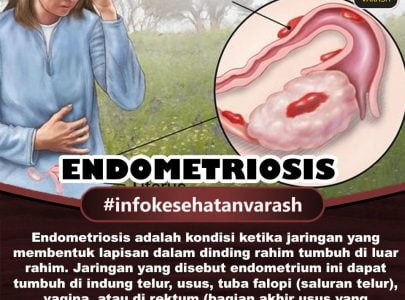 Penyebab Endometriosis dan Pengobatan Dengan Varash