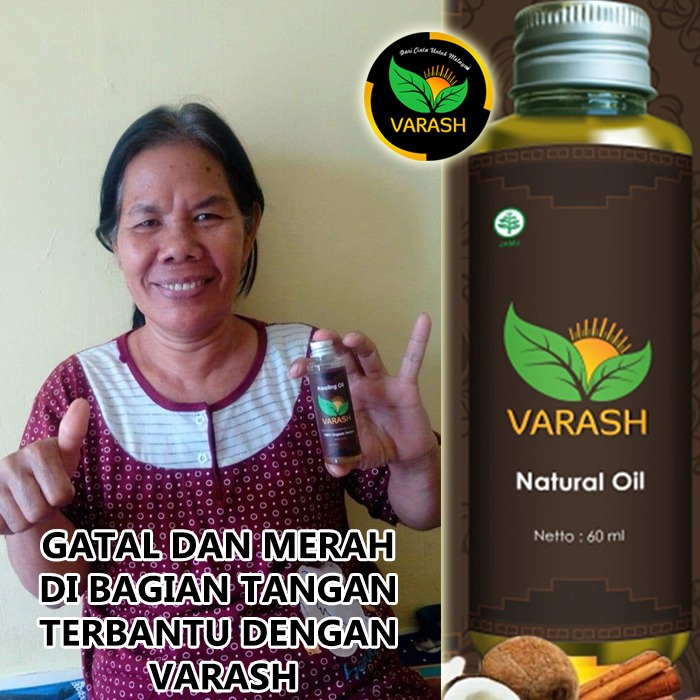 gatal bintik merah terbantu varash natural classic oil