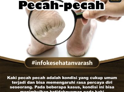 Penyebab Kulit Kaki (Tumit) Pecah-pecah