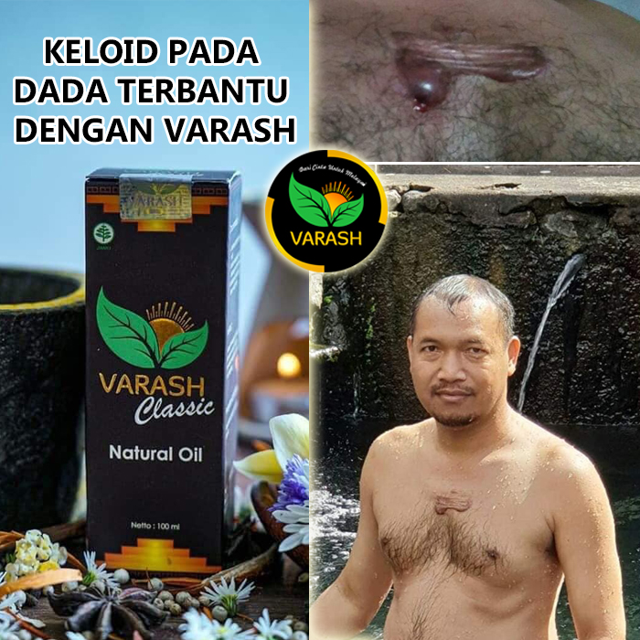 keloid di dada terbantu varash natural classic oil
