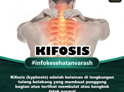 Apa Penyebab Kifosis dan Bagaimana Pengobatannya