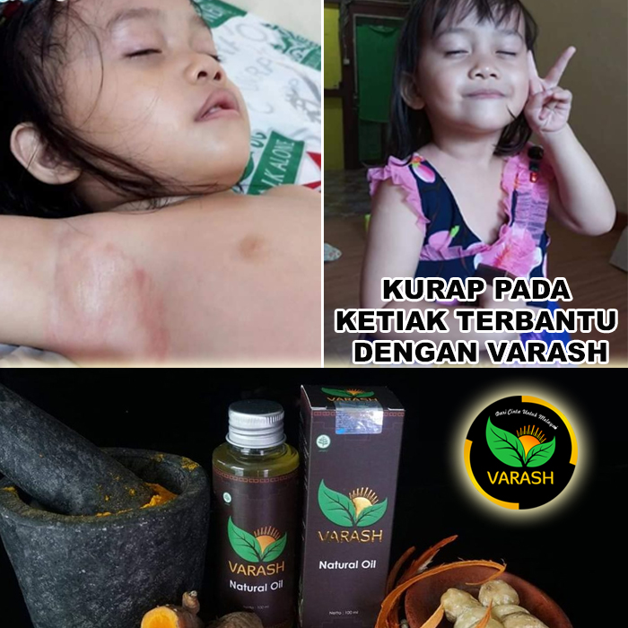kurap terbantu varash natural classic oil