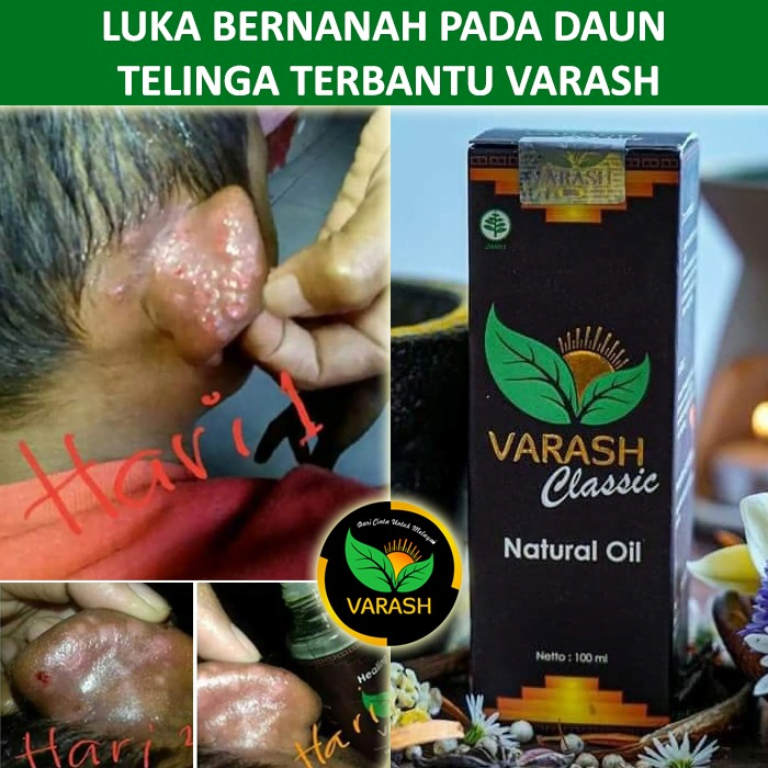 luka bernanah terbantu varash natural classic oil