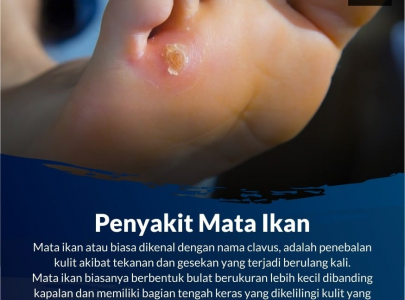 MATA IKAN TERBANTU DENGAN MINYAK VARASH