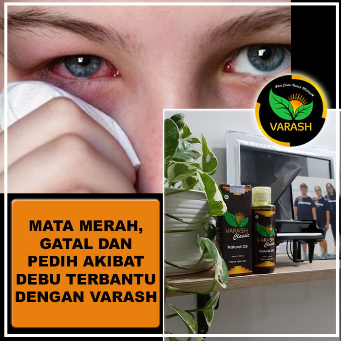 mata merah, gatal, pedih, terbantu dengan varash natural oil