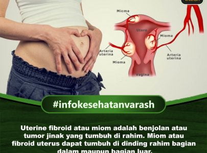 Penyebab Miom dan Pengobatan Dengan Varash