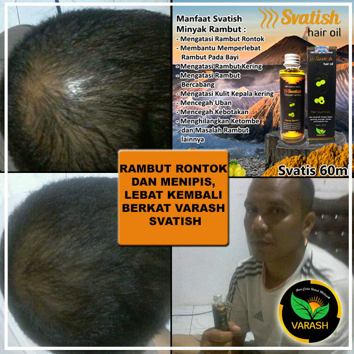 rambut rontok terbantu dengan varash svatish oil