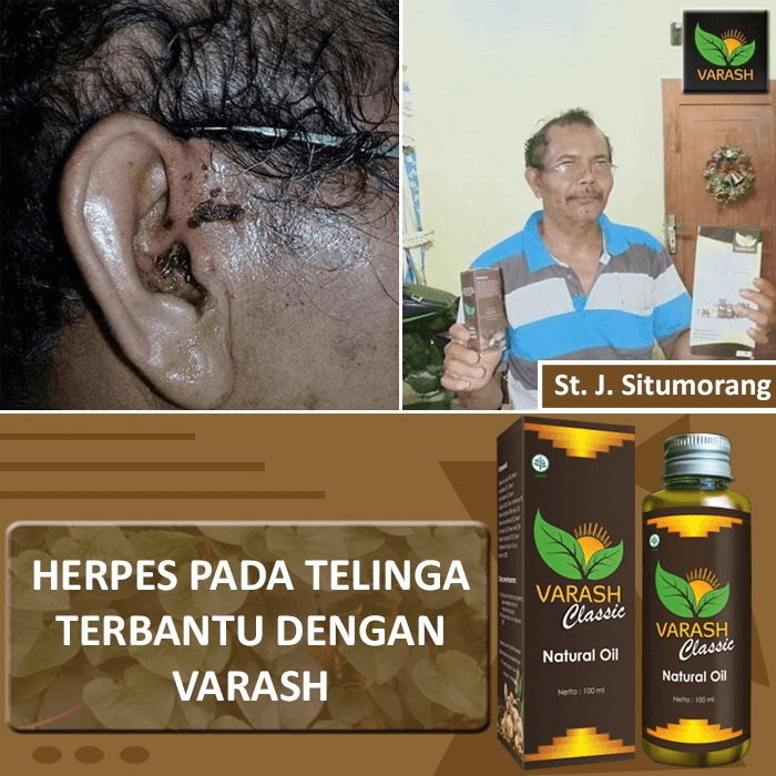 herpes pada telinga terbantu varash natural classic oil