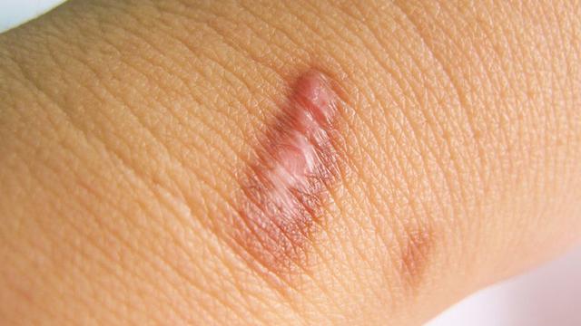 Hasil gambar untuk keloid