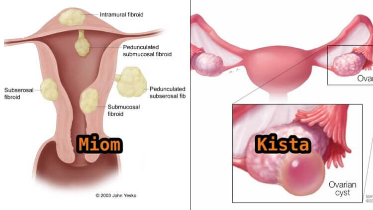 pengobatan miom dan kista ovarium dengan varash