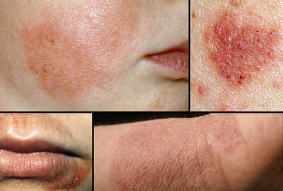 Hasil gambar untuk Dermatitis Atopik