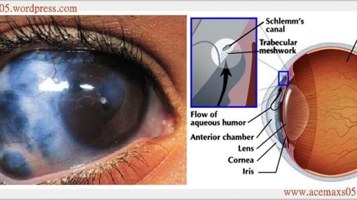 Hasil gambar untuk glukoma