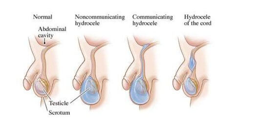 Hasil gambar untuk hidrokel