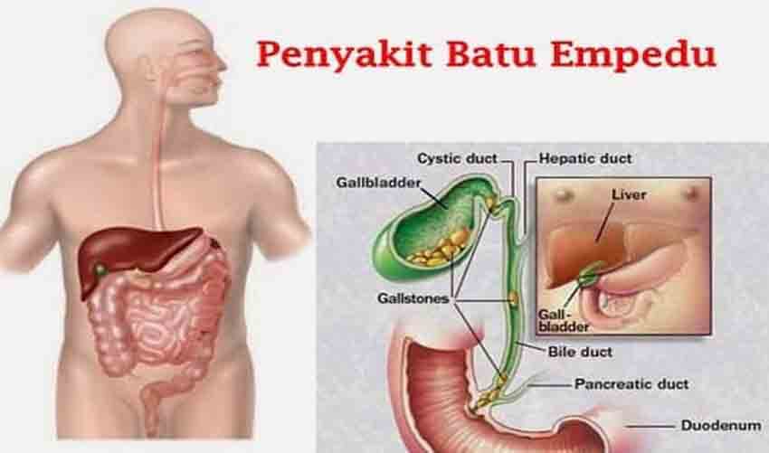 Hasil gambar untuk batu empedu