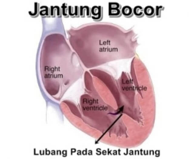 Hasil gambar untuk JANTUNG BOCOR