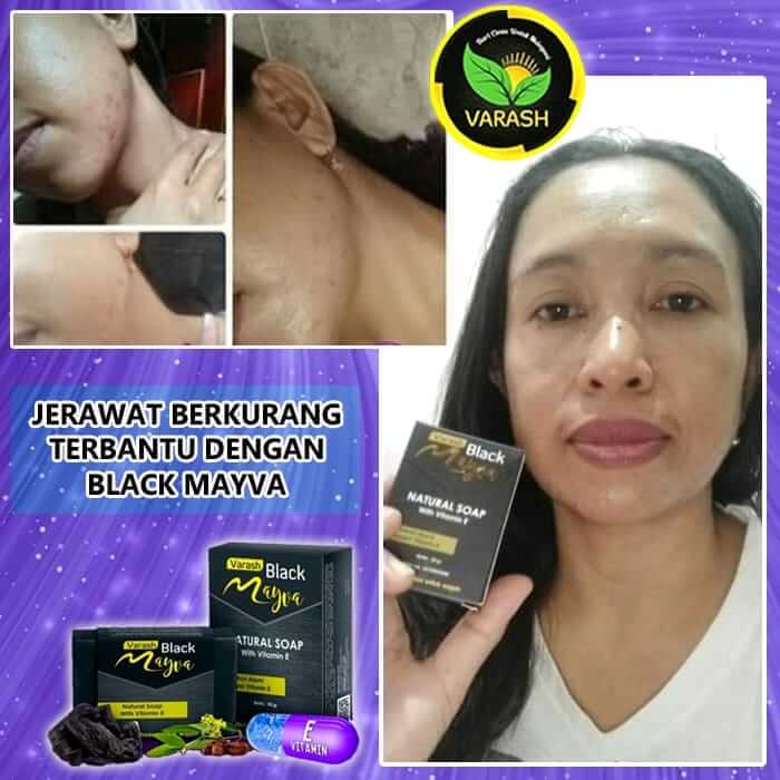 JERAWAT BERKURANG TERBANTU DENGAN BLACK MAYVA