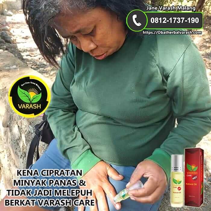 TERKENA CIPRATAN MINYAK PANAS & TIDAK JADI MELEPUH BERKAT VARASH CARE