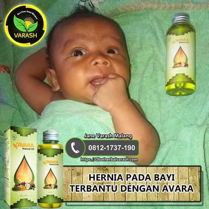 HERNIA PADA BAYI TERBANTU DENGAN AVARA