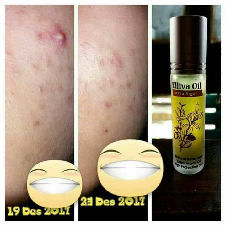 MATA PANDA (KANTONG MATA) & JERAWAT TERATASI DENGAN VARASH ELLIVA OIL